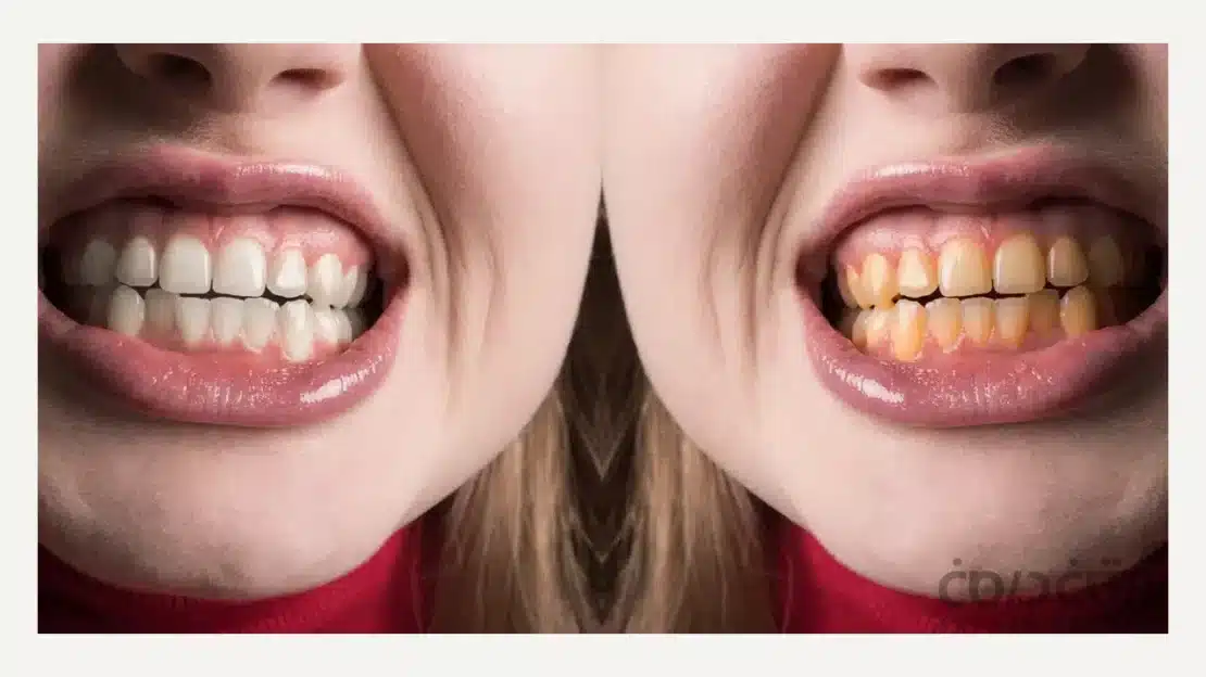 قبل و بعد از بلیچینگ دندان