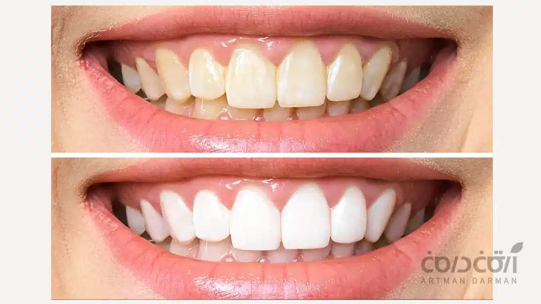درجه سفیدی دندان قبل و بعد از درمان