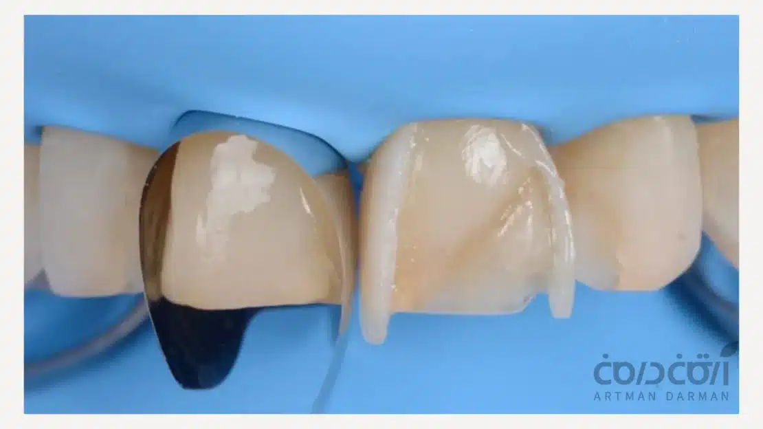 کامپوزیت دندان