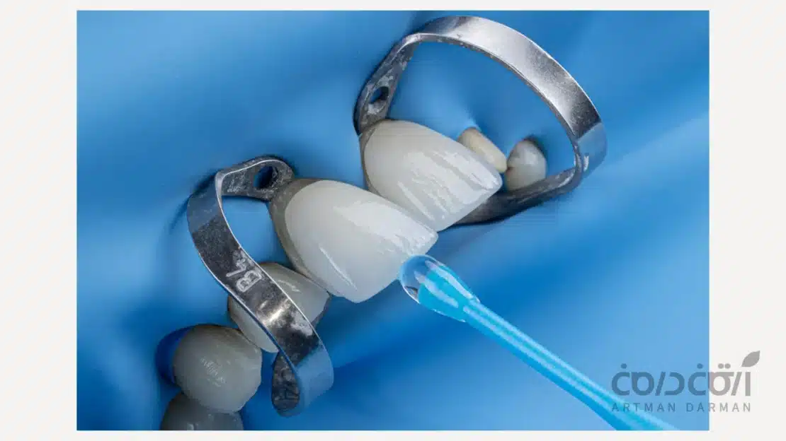 لمینت دندان