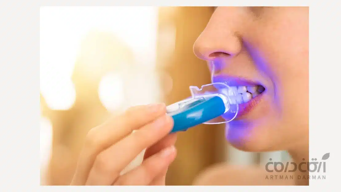 بلیچینگ دندان در خانه
