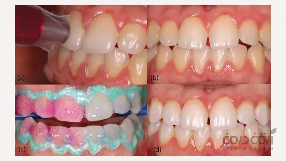مراحل درمان در مطب