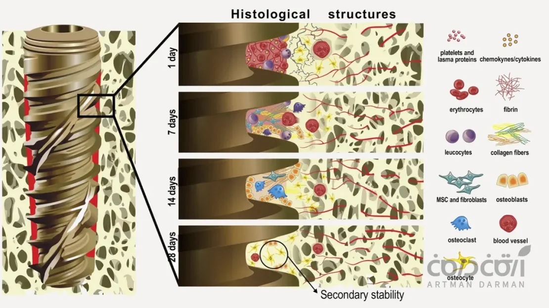 Osseointegration