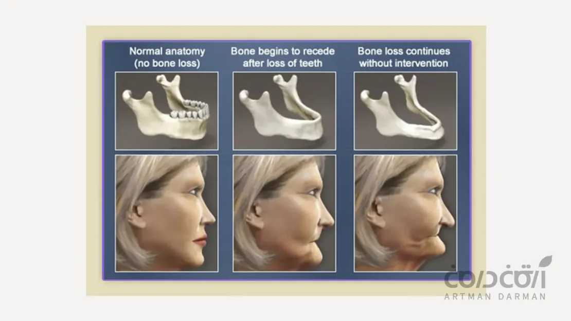 مراحل تحلیل استخوان فک