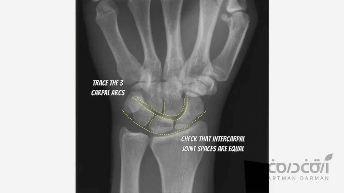 عکس رادیوگرافی از مچ دست راست برای تعیین سن مناسب ایمپلنت دندان