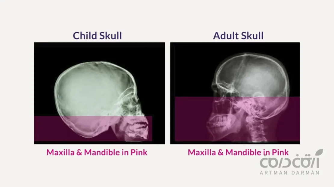 رشد فکی در کودک و بزرگسال برای تعیین سن مناسب ایمپلنت دندان