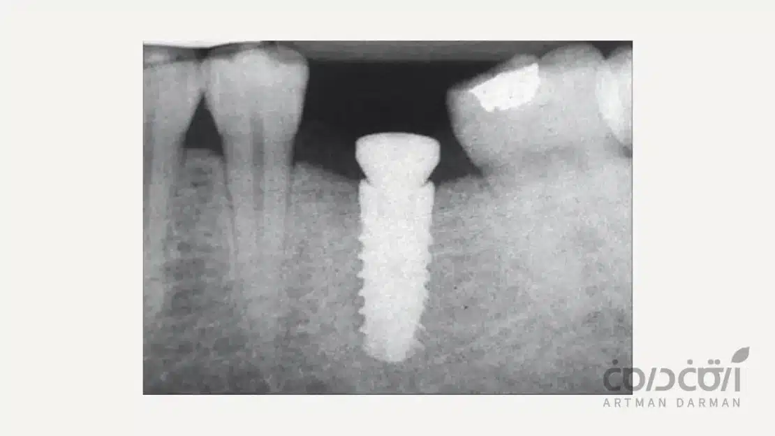 فرآیند اوسئواینتگریشن