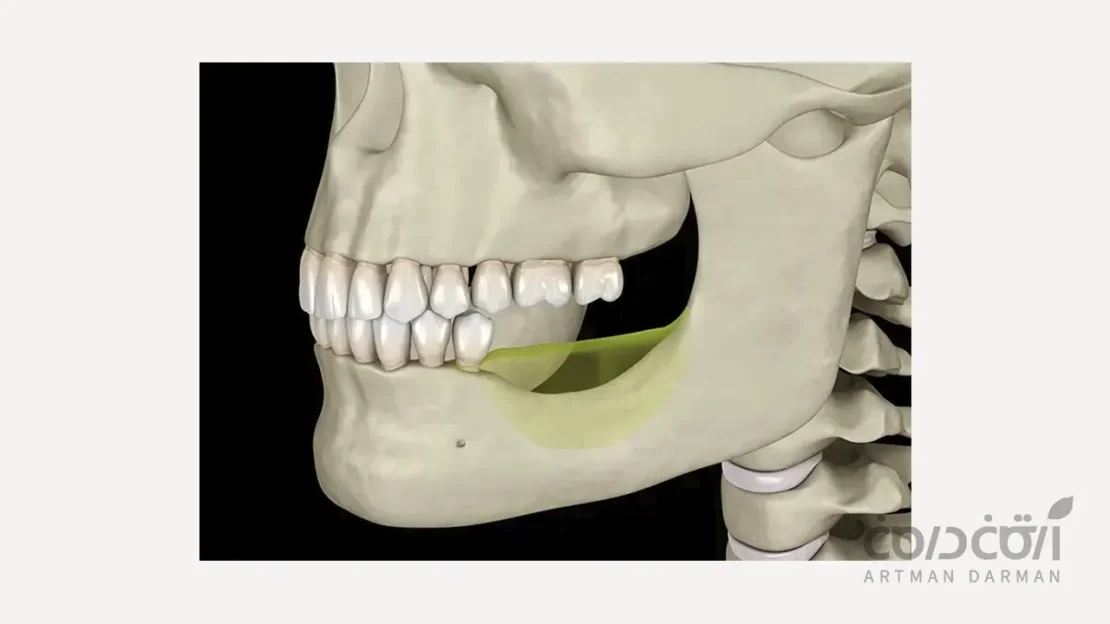 تحلیل در ناحیه بی دندانی و نیاز به پیوند استخوان برای ایمپلنت دندان