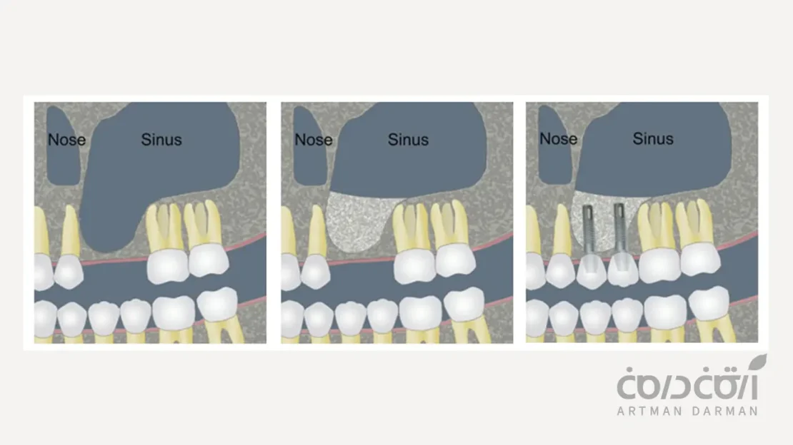 عمل لیفت سینوس