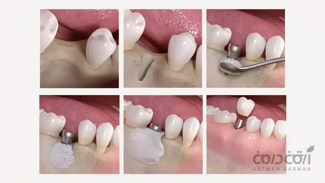 مراحل پیوند استخوان برای ایمپلنت دندان