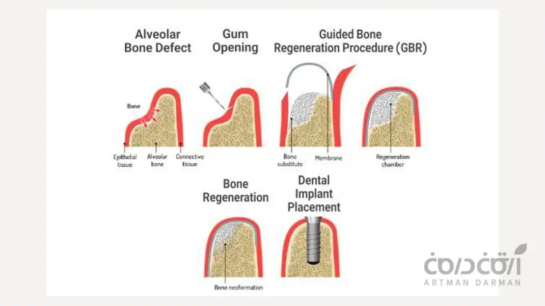 بازسازی هدایت شده استخوان