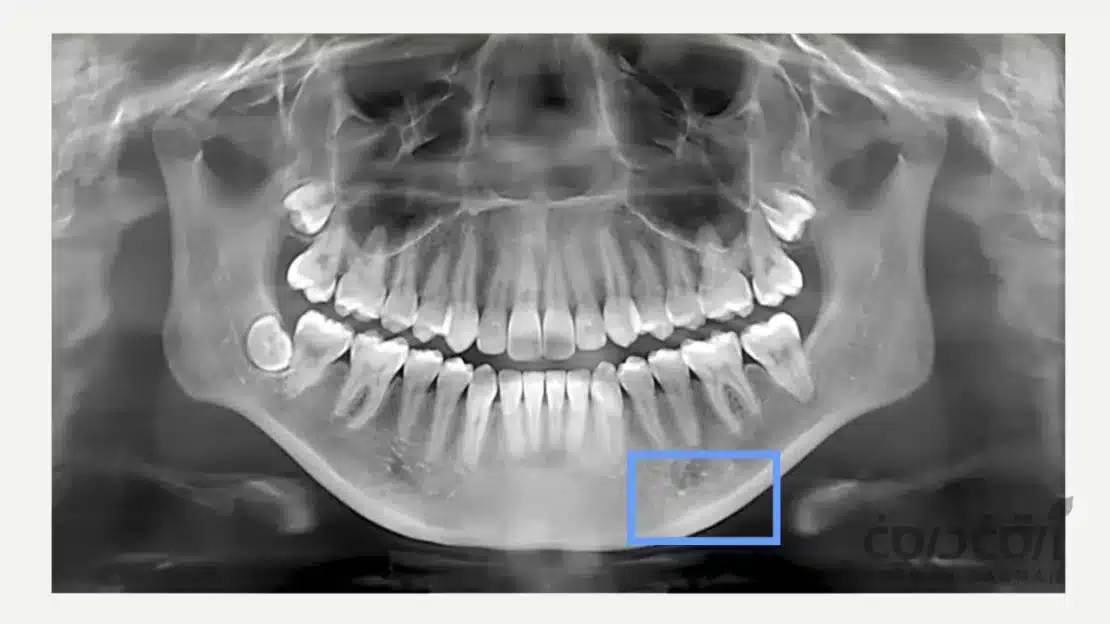 عکس رادیوگرافی نشان دهنده پوکی استخوان فک برای تعیین سن مناسب ایمپلنت دندان