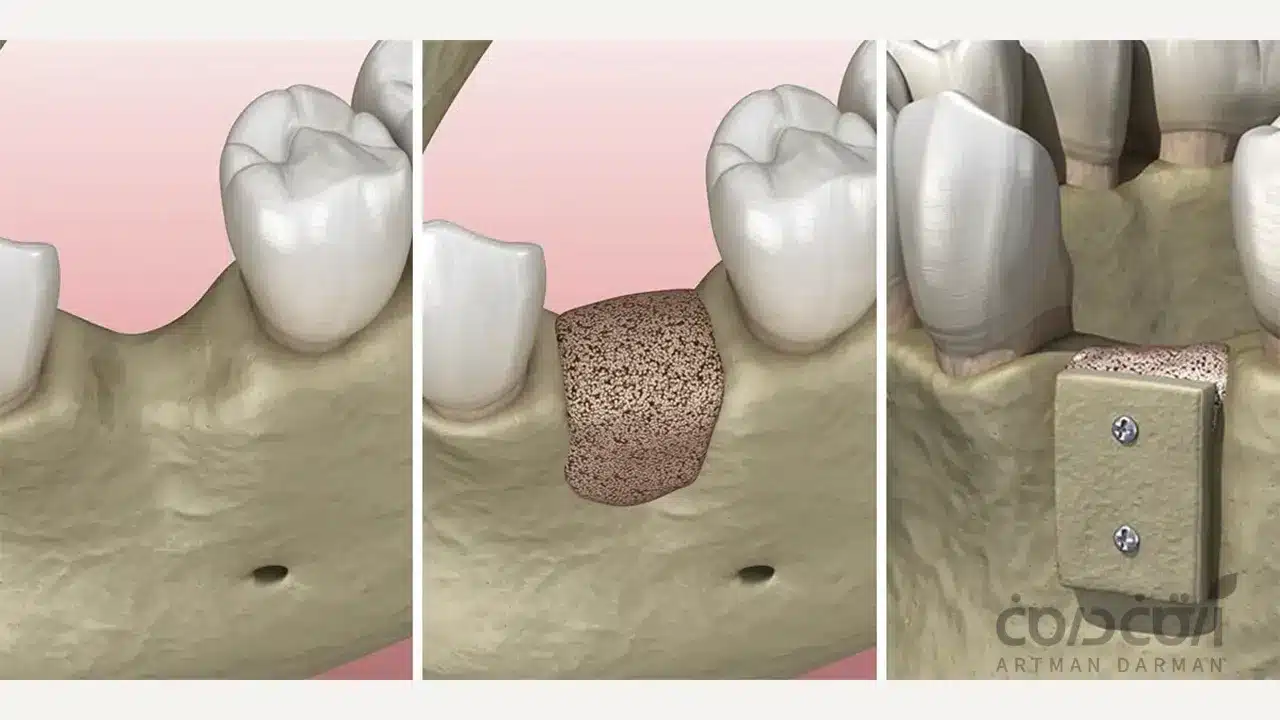 تصویر پیوند استخوانی
