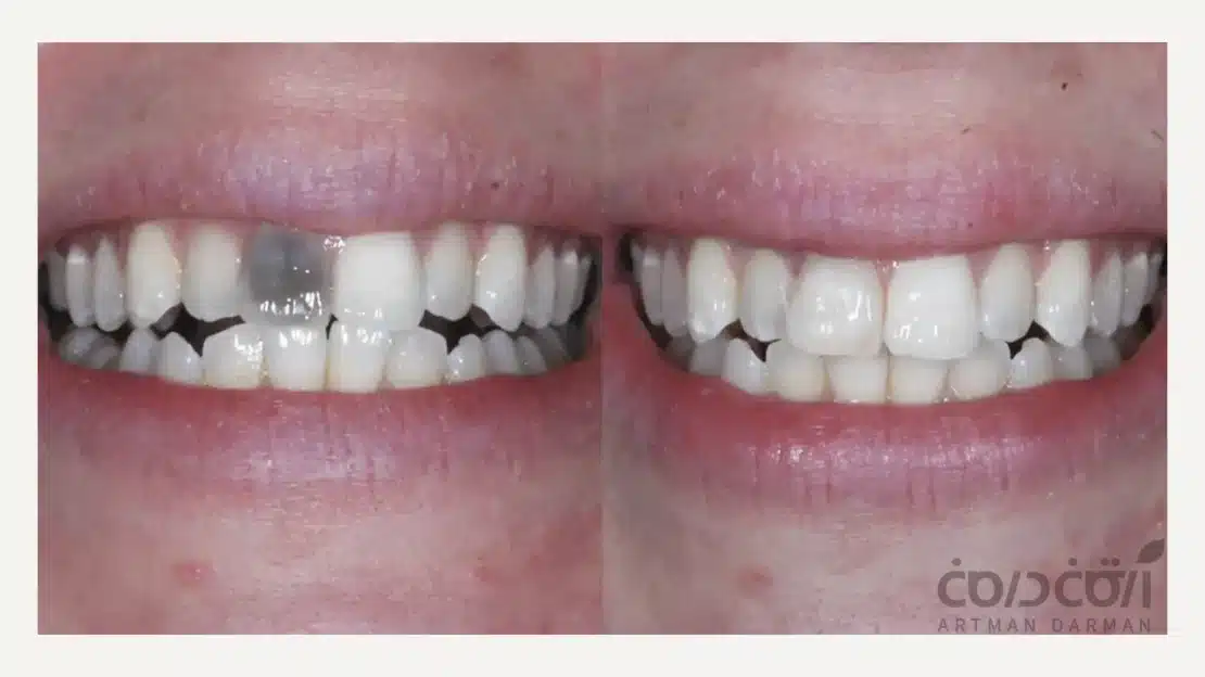 قبل و بعد از درمان سیاه شدن دندان جلو