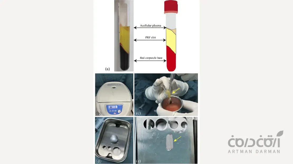 Platelet-Rich Fibrin
