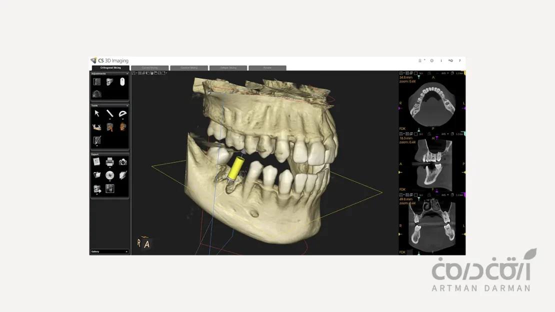 تصویر CBCT