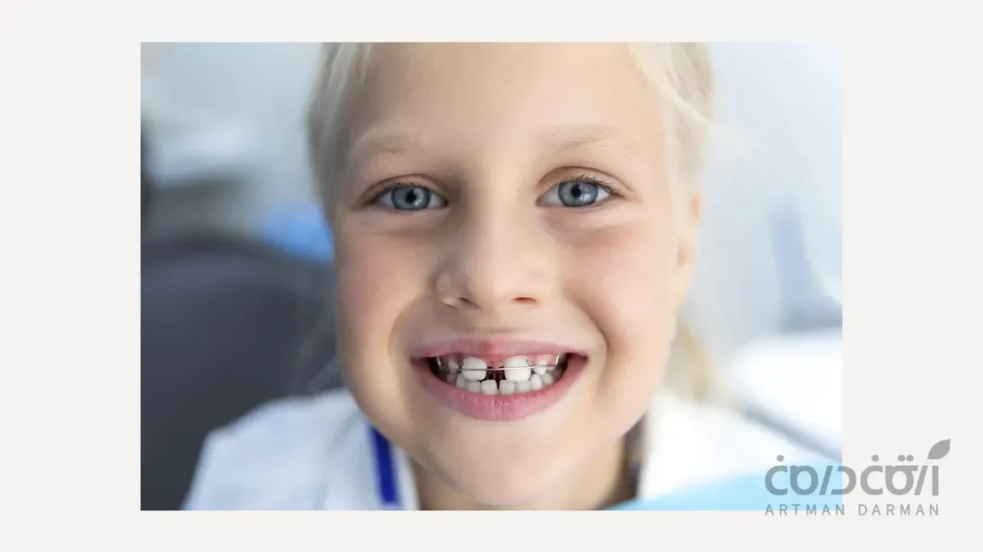 بستن فاصله بین دندان ها در دوران کودکی