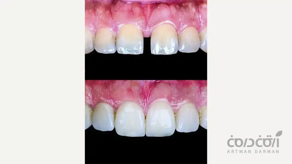 بستن فاصله بین دندان ها