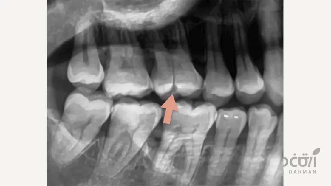 رادیوگرافی دندان شکسته