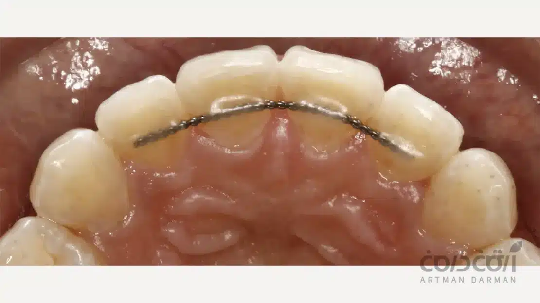 استفاده از ریتینر ارتودنسی بعد از رفع فاصله بین دندان ها