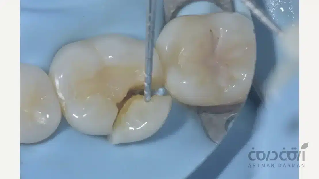 مراجعه به موقع برای ترمیم دندان شکسته