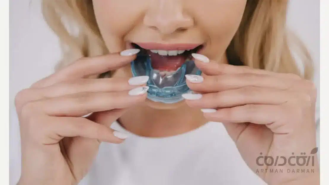 نایت گارد برای مراقبت از درمان بیلداپ شده در افراد دچار دندان قروچه