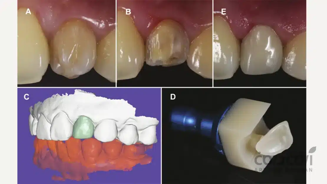 CAD-CAM در ساخت لمینت