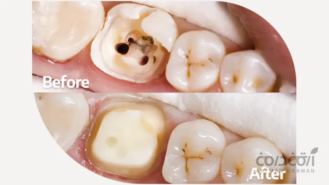 آماره سازی دندان برای روکش