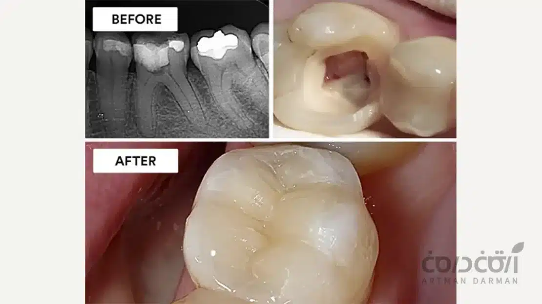 بیلداپ دندان درمان ریشه شده