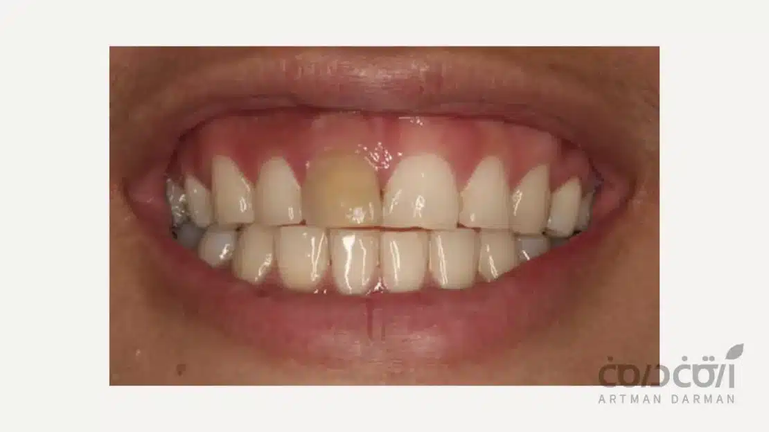 دندان درمان ریشه شده و تغییر رنگ داده