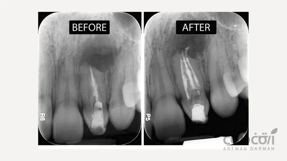 رادیوگرافی از دندان درمان ریشه شده