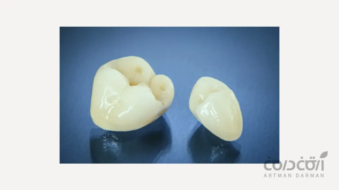 روکش تمام سرامیک