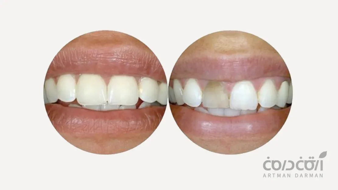 لمینت دندان عصب کشی شده