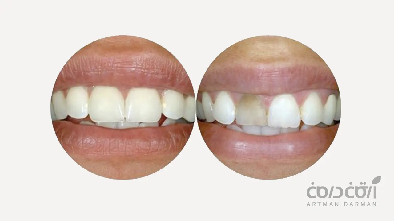 لمینت دندان عصب کشی شده