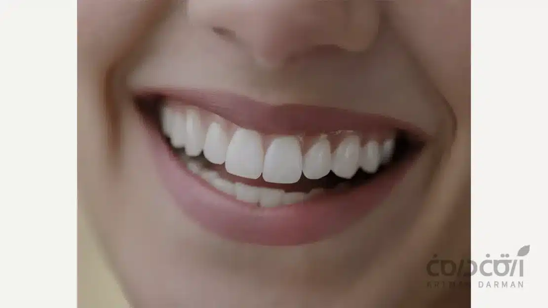 تصویری از لمینت دندن نیش بیرون زده