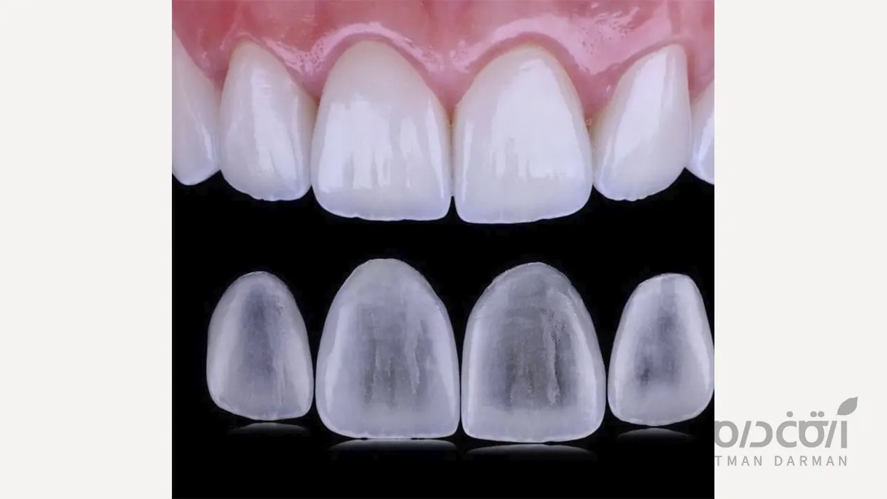 لمینت سرامیکی دندان