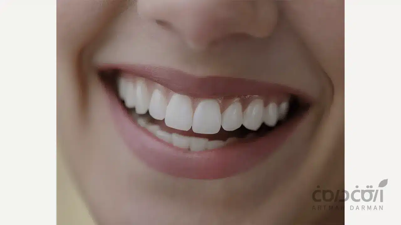 تصویری از لمینت دندن نیش بیرون زده