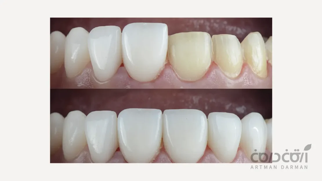 قبل و بعد از لمینت دندان