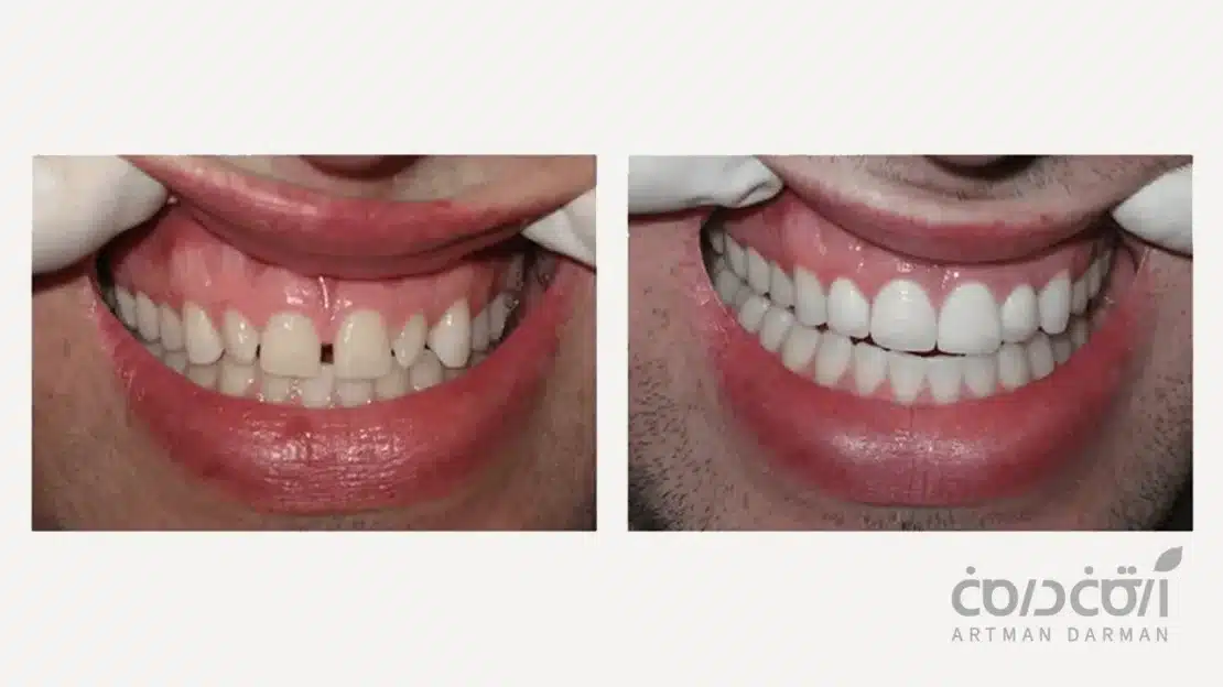 لمینت دندان نیش بیرون زده