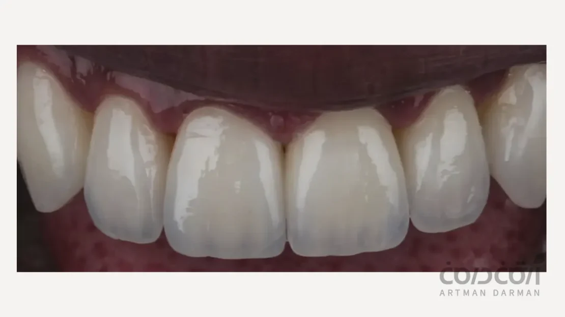 لمینت دندان گلس-سرامیک