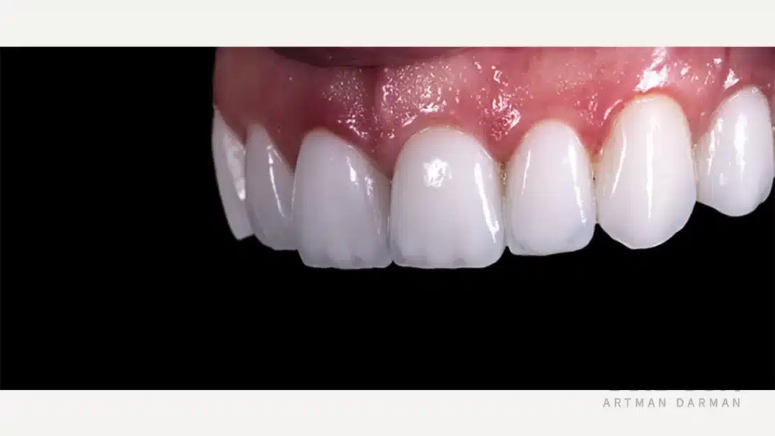 لمینت سرامیکی دندان