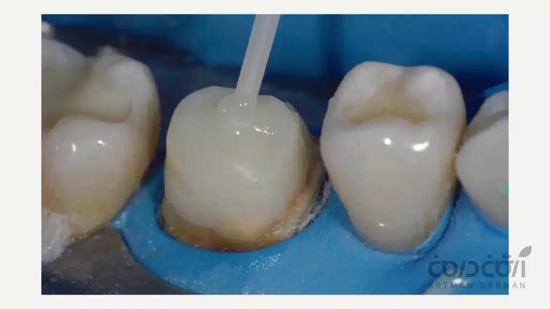 مراحل انجام بیلداپ