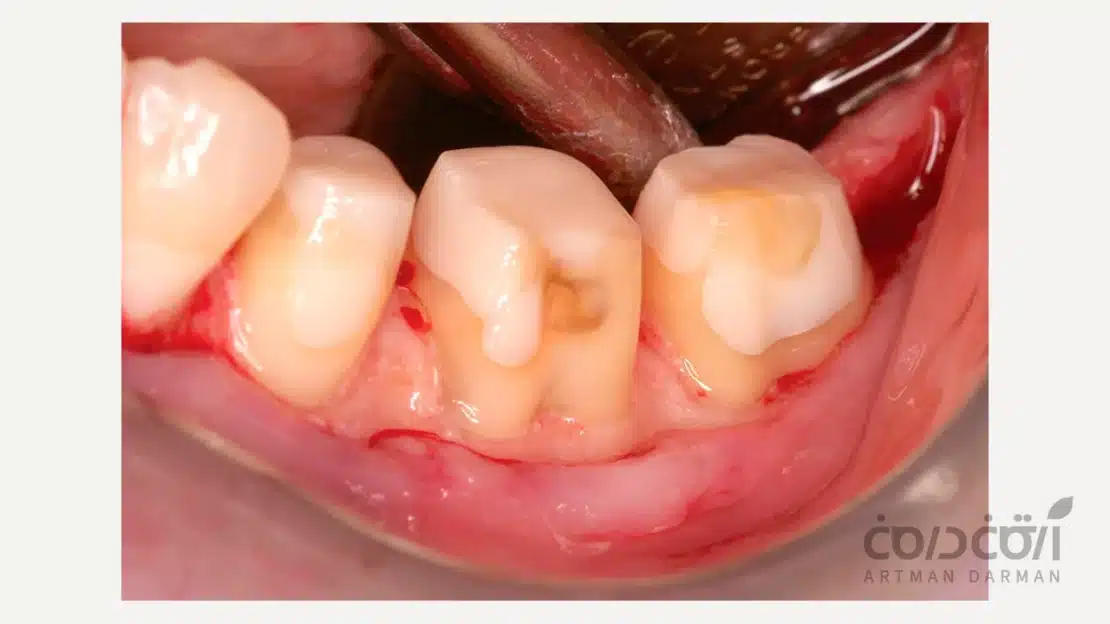 تصویری از بعد از درمان