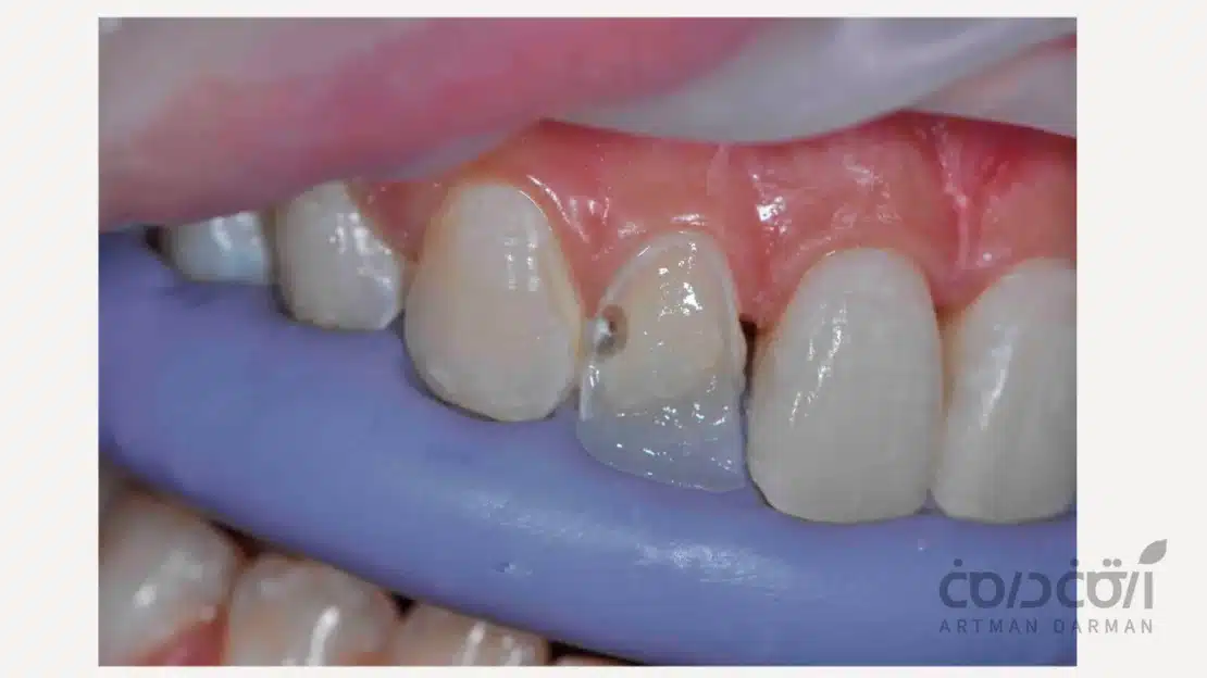 بیلداپ کامپوزیت دندان جلو