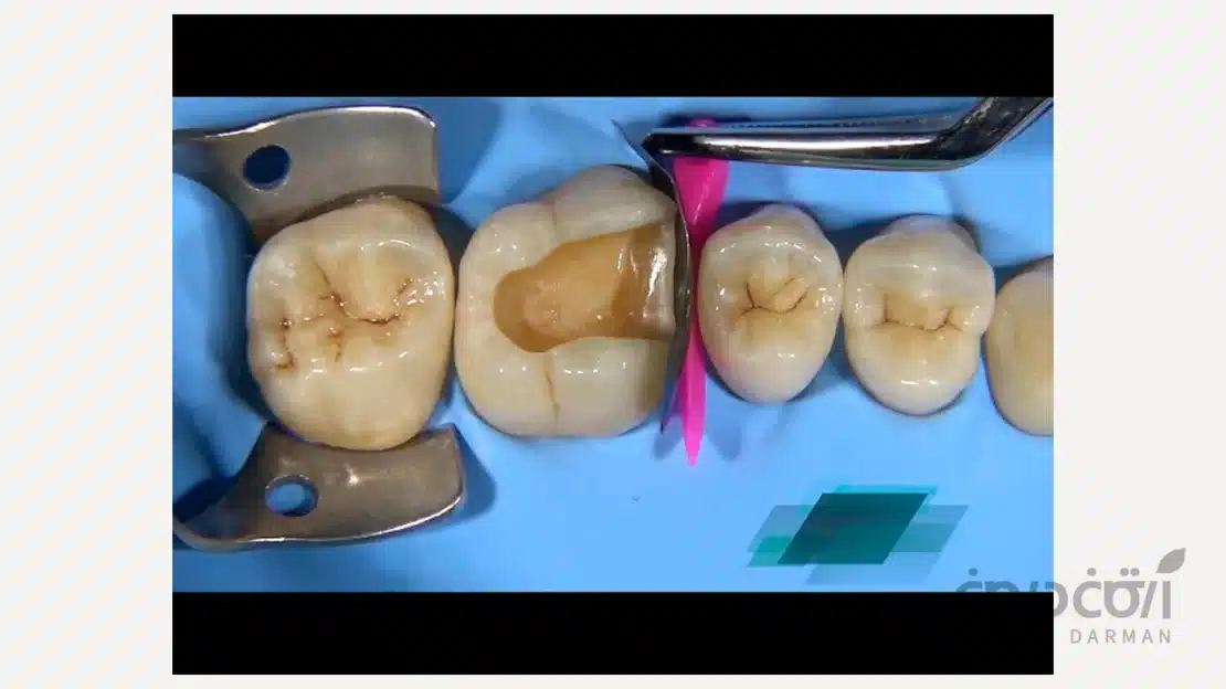 آماده کردن دندان برای درمان بیلداپ کامپوزیت