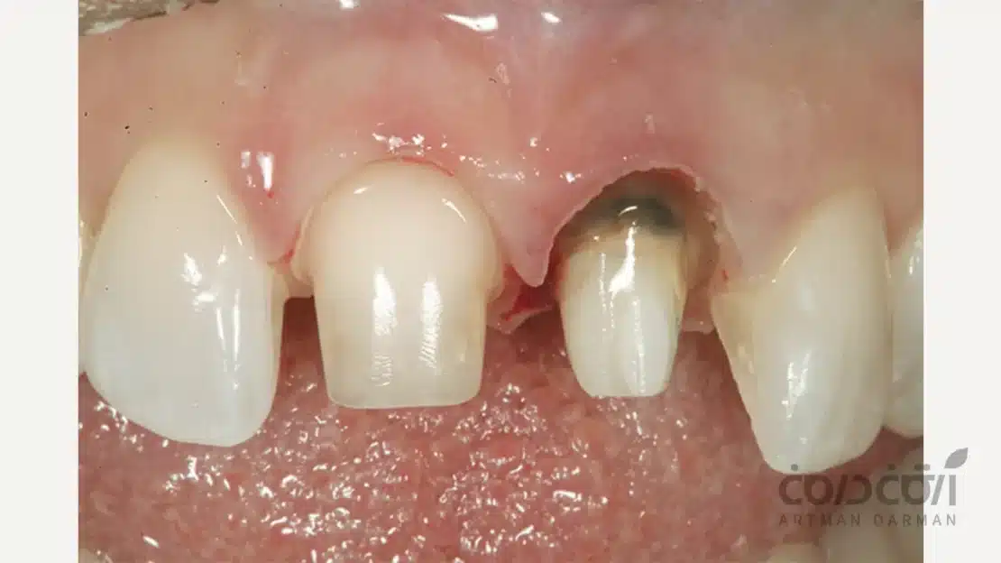 آماده سازی برای روکش دندان