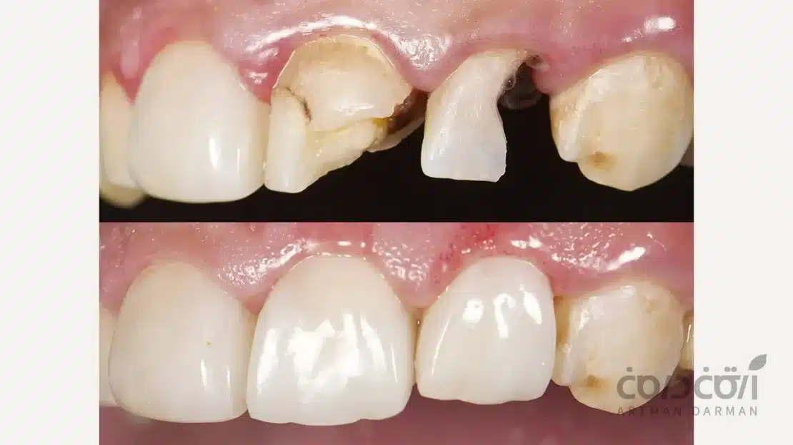 بیلداپ دندان جلو