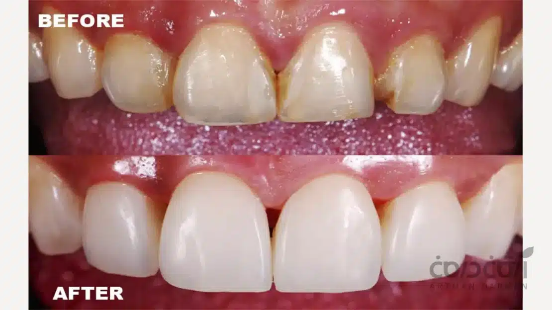 ونیر کامپوزیت دندان جلو