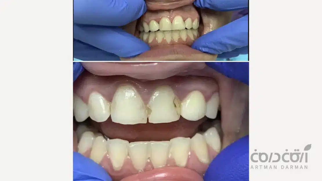 باندینگ کامپوزیت دندان جلو