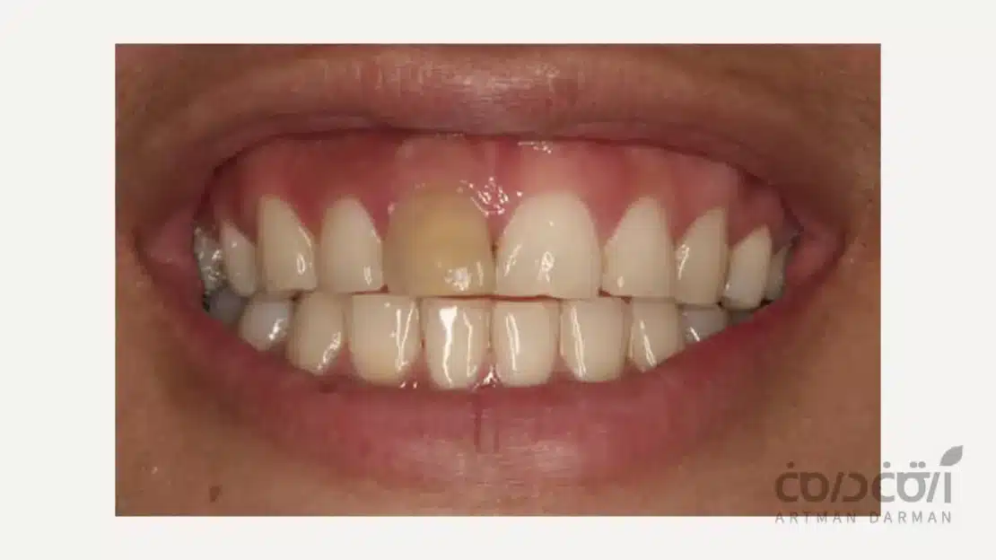 تغییر رنگ دندان بر اثر درمان ریشه دندان